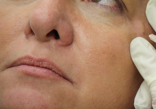 Can Estheticians Inject Botox in Georgia?